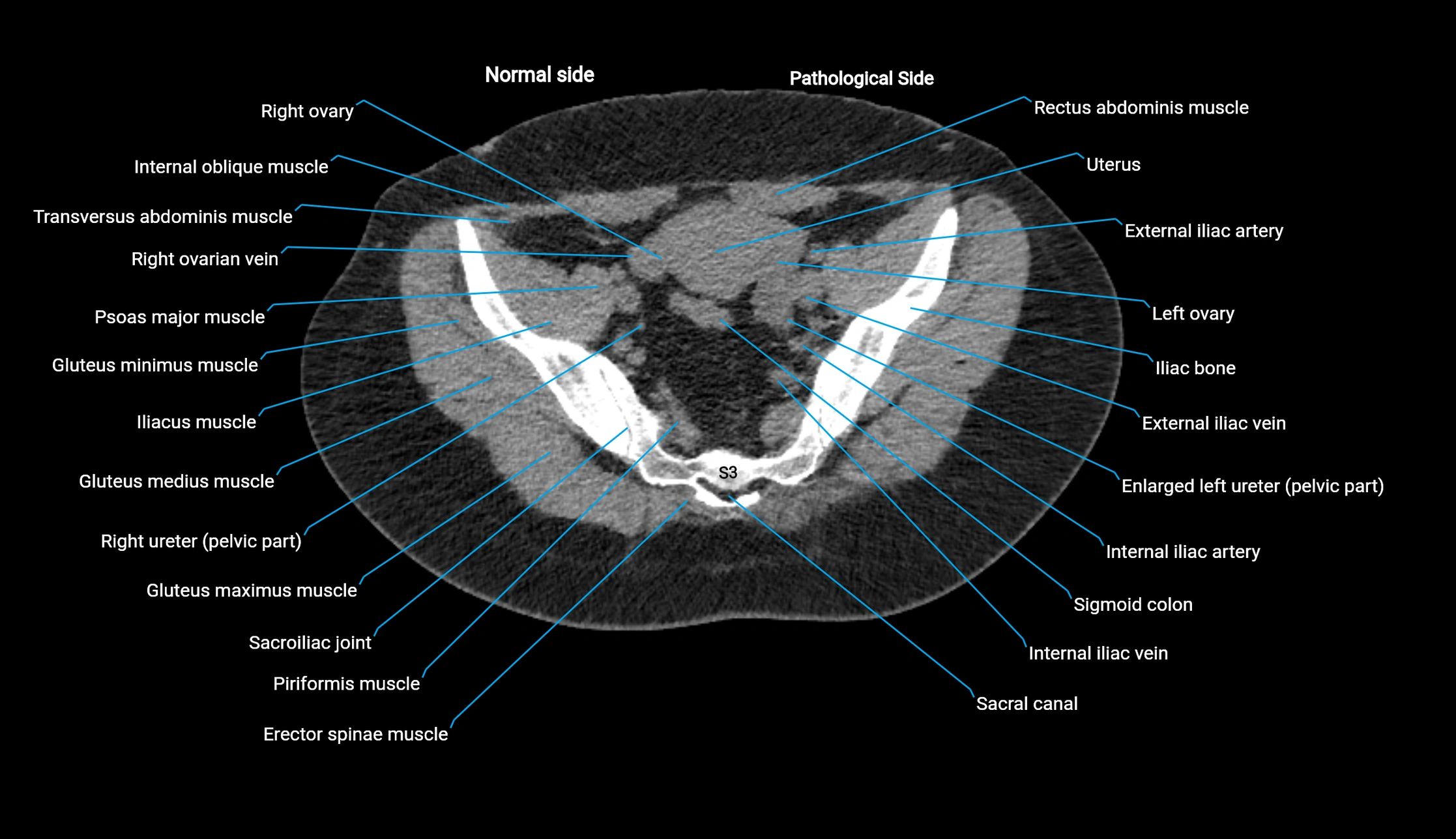 CT KUB axial cross sectional anatomy  radiology image -img-00201-00131.webp